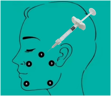 32mg H-HA L-HA Çapraz Bağlantısız Hyaluronik Asit Dolgu Hyaluronik Asit Jeli