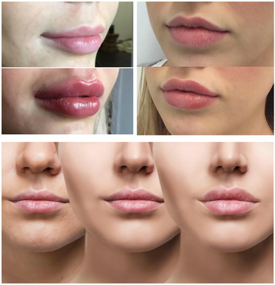 Hyaluronik Asit Enjekte Edilebilir Dolgu Maddesi ile Pürüzsüz Çizgiler / Dolgun Dudaklar 1ml 2ml 5ml