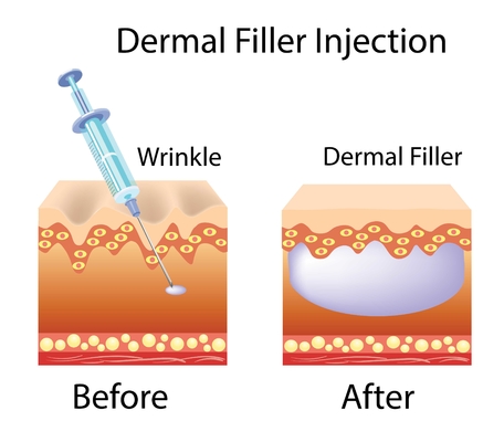 Hyaluronik Asit Doldurucu Üreticisi Yüz Vücut için Enjekte edilebilir Modifiye Sodyum Hyaluronat Gel