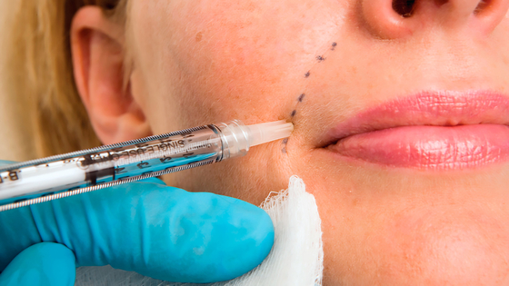 50 ml Enjekte edilebilir Hyaluronik Asit Dermal Lidocaine PCL Plla Filler Enjeksiyonlu Yüz Çene Dolguyu