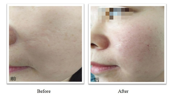 350 mg 150 mg PLLA Dermal Filler OEM Özellik Enjekte edilebilir Plla Uzun Süren Sonuçlar İçin