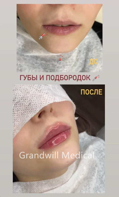 24mg/ml Kıvrım Yumuşatıcı Enjekte edilebilir Hyaluronik Asit Dermal Dolgu