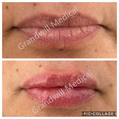 Dudak Büyütme Enjekte Edilebilir Hyaluronik Asit Jel Dermal Dolgu 1ml 2ml