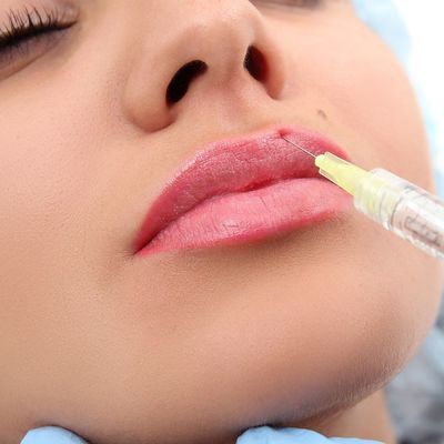 Dudaklar Yüz Göğüs Kalça Enjeksiyonu İçin Jel Çapraz Bağlantılı Hyaluronik Asit Dolgusu