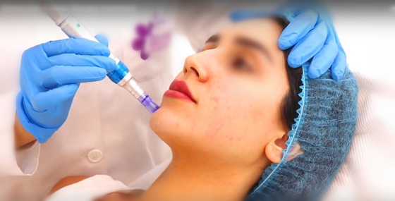 10ml 100% 20mg saf çapraz bağlı olmayan hyaluronik asit enjeksiyon derma kalemi için dermal dolgu maddesi