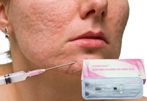 İnce Yüz Kırışıklıklarını Gidermek İçin 1ml Sodyum Hyaluronat Jel Enjeksiyonu