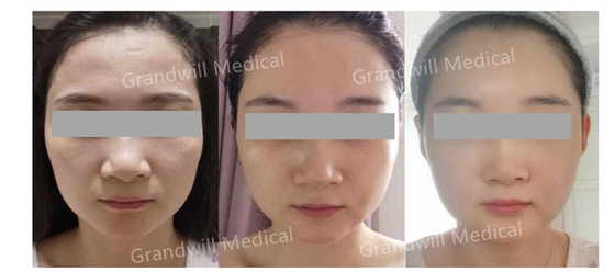Hyaluronik Asit PCL Cilt Güçlendirici Mucize Rötuş Cilt Kollajen Stimülatörü