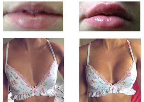 Göğüs Büyütme Enjeksiyon Dolgu Hyaluronik Asit implant Dudak Enjeksiyonları Dermal Dolgu