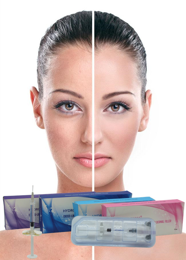 Profesyonel kırışıklık doldurucu 24mg/ml Yüz için Hyaluronik Asit Çapraz Bağlı Sodyum Hyaluronat Enjekte edilebilir