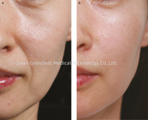 Miracle HL PCL Skin Booster Fine Line Polycaprolactone Hyaluronik Asit Enjeksiyon Dolguyu